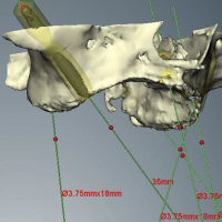 Nueva técnica en implantes cigomáticos que reduce el riesgo de sinusitis.